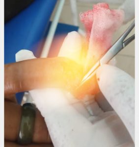 Oknum TNI AD Aniaya Seorang Warga, Jari Korban Nyaris Putus